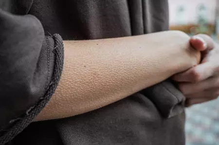 De ce se face pielea de găină şi cum apare această reacţie