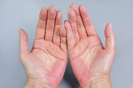 Ce semnificație are culoarea palmelor – ce probleme medicale pot indica