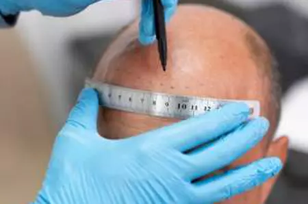 Un bărbat a decedat, în urma unui implant de păr, realizat în Turcia. Acesta fusese supus și unei intervenții stomatologice