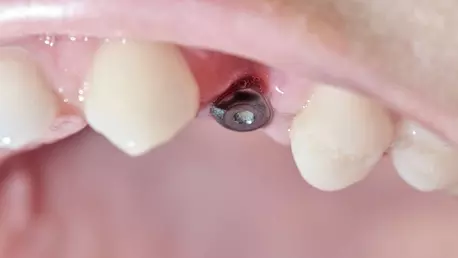 Primele Semne că Ai Nevoie de un Implant Dentar