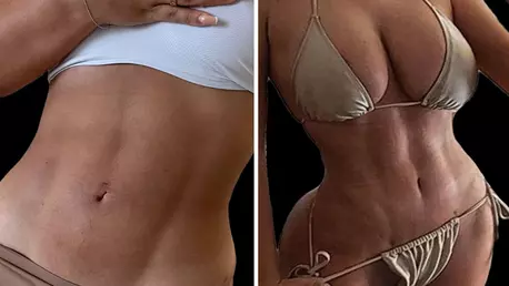 Beneficiile liposucției abdominale Vaser HD, cea mai populară intervenție estetică în rândul vedetelor din România. Cum trebuie să te pregătești