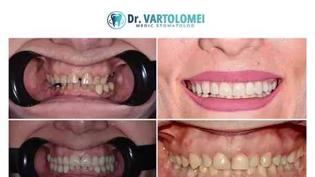 Zâmbet natural și estetica dentară responsabilă: ce trebuie să știi înainte de fațete dentare