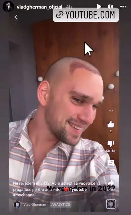 Vlad-Gherman-si-a-facut-implant-de-par