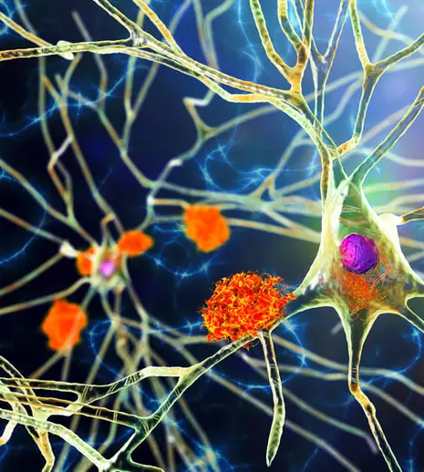 13 vedete cu afecțiuni neurodegenerative