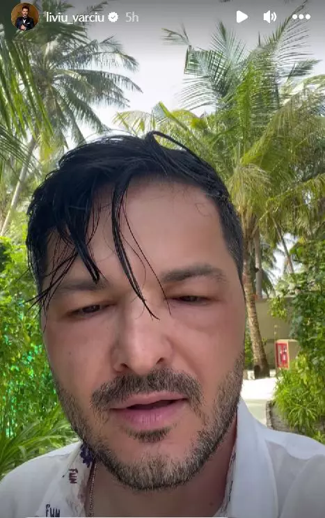 liviu-varciu-s-a-trezit-cu-fata-umflata-in-vacanta-7