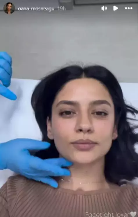 oana-mosneagu-facelift