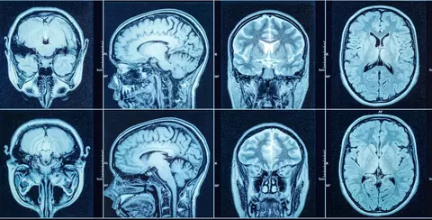 Atrofierea creierului post Covid, probată de studii. Opinia medicului neurolog