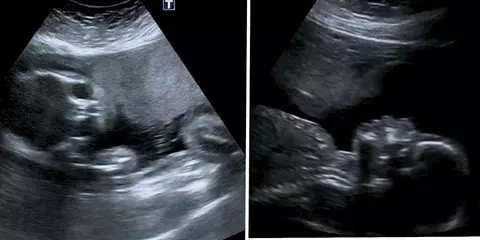 O femeie spune că ar fi văzut un înger păzitor lângă fătul ei, în ecografie. Ea pierduse deja trei sarcini