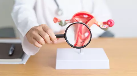 Reteta (P) Endometrioza poate fi vindecată? Ce opțiuni de tratament sunt?