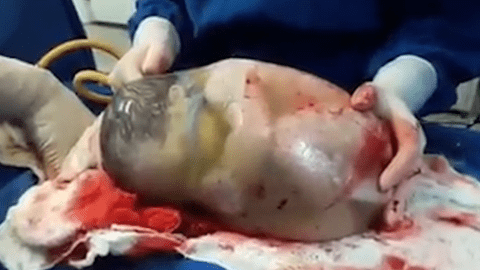 Un bebeluș s-a născut cu sacul amniotic intact. Uite cum se comportă crezând că e în burta mamei | VIDEO
