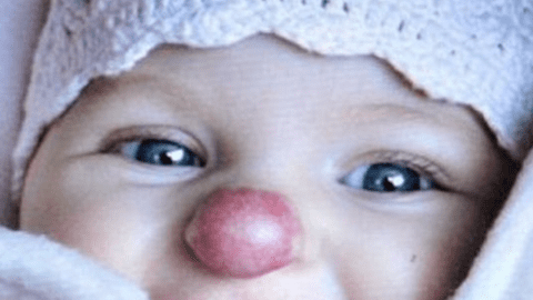 Cum arată astăzi fetița cu "nasul lui Rudolf", născută cu hemangiom. Este adolescentă și a scăpat de complexele din copilărie