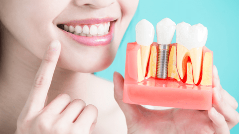 (P) Implantul dentar – soluția perfectă pentru recâștigarea zâmbetului