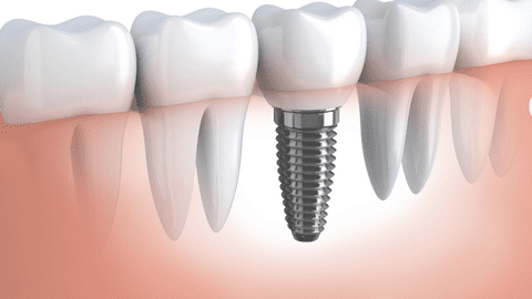 (P) De ce să alegi un implant dentar MIS C1