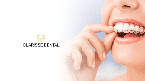 Avantajele aparatelor dentare invizibile pentru alinierea și îndreptarea dinților