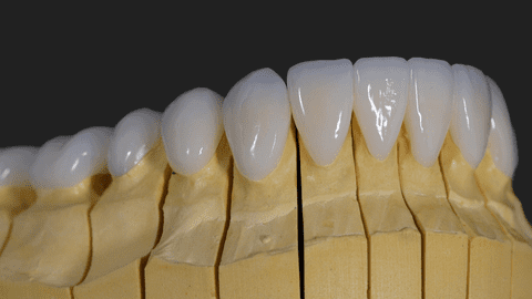 Estetică Naturală vs. Hollywood Smile: Fațetele Dentare și Drumul către Zâmbetul Visat