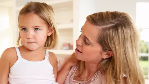 Varicela – simptome şi tratament