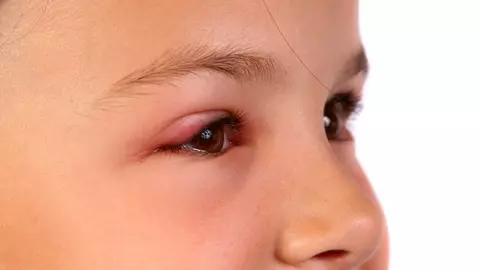 Are pleoapele umflate - de ce?