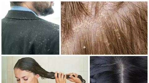 Cel mai simplu remediu natural pentru mătreaţă