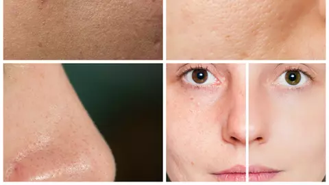 Tratament natural pentru ten gras şi pori dilataţi