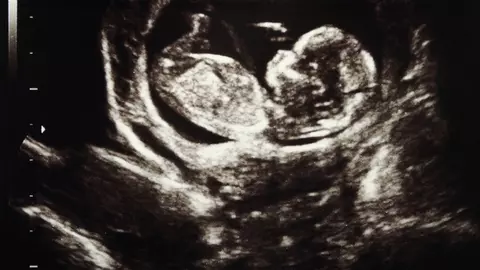 Sarcina oprită în evoluţie – ce trebuie să ştii