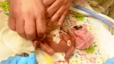 Imaginile unui adevărat miracol. Primul an din viața unui prematur născut la 24 de săptămâni | VIDEO