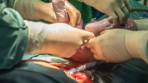 Cate cezariene poate face o femeie?