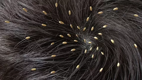 Cum previi infestarea cu paduchi