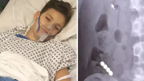 A inghitit patru magneti si a ajuns la spital in pericol de moarte