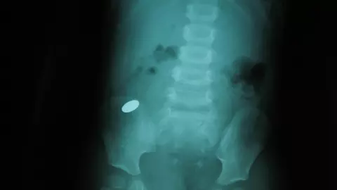 Ce faci atunci cand copilul inghite un corp strain