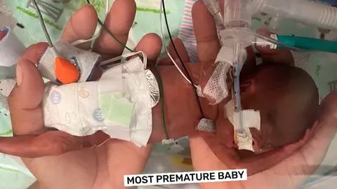 Un bebeluș prematur născut la 21 de săptămâni de sarcină a  intrat în Cartea Recordurilor