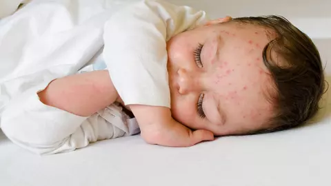 A reapărut rujeola. Boala dispăruse în 2020 odată cu restricțiile anti-Covid