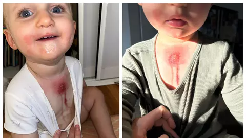 O femeie trage un semnal de alarmă după ce băiatul ei s-a ales cu arsuri grave pe piele din cauza unui aliment comun