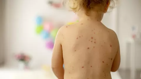 Un copil nevaccinat, din Buzău, a murit de rujeolă