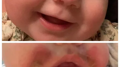 O fetiță riscă să rămână cu cicatrici pe față din cauza unei reacții avute după ce a mâncat legume