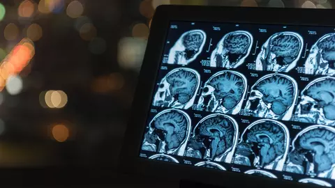 O fetiță a murit la câteva zile după ce medicii au descoperit că fătul surorii ei gemene îi creștea în craniu