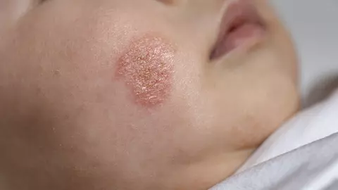 Infecțiile fungice ale pielii: diagnostic rapid în cabinetul de dermatologie
