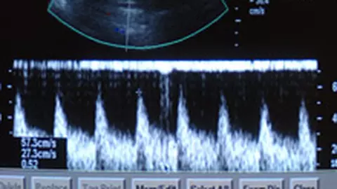 Placenta previa - Ce este, care sunt simptomele și cum se tratează