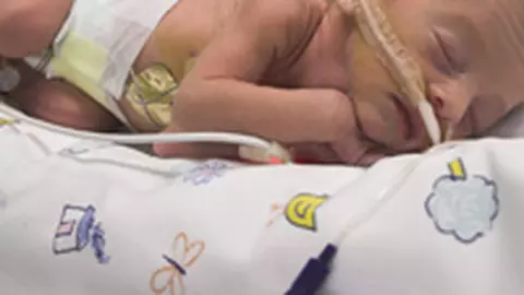 Problemele de sanatate ale nou-nascutului prematur