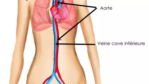 Ateroscleroza - ucigaşul care ne pândeşte