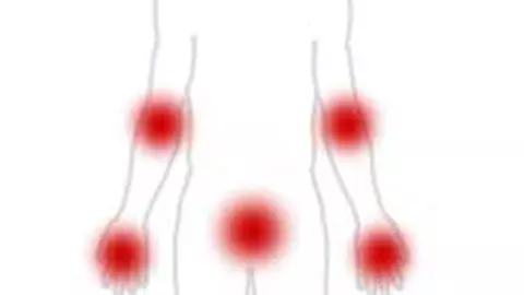 Psoriazis – boala genetica de piele