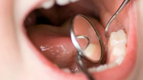 Cu copilul la medicul dentist. Sigilarea molarilor de 6 ani