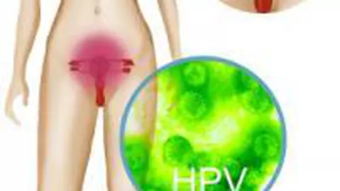 HPV - virusul care te poate ucide