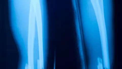 Osteoporoza și fractura osului cu osteoporoză. EXPERIMENT