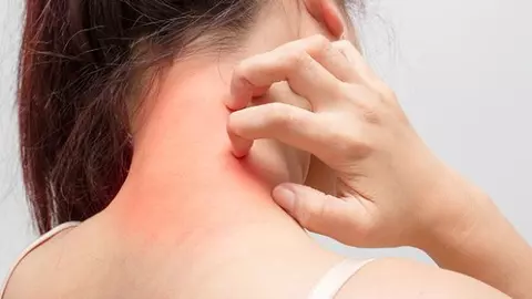 Ai grijă de bijuterii porți dacă ai dermatită de contact