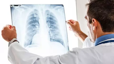 Complicațiile care pot apărea în urma unei pneumonii Covid-19