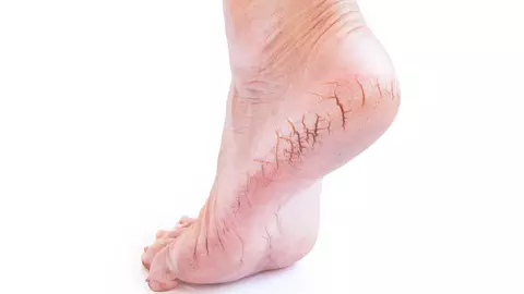 Cele mai eficiente tratamente naturale împotriva bătăturilor