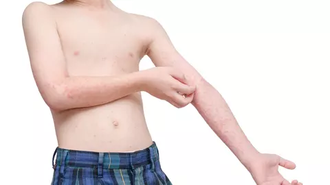 Tot ce trebuie să știi despre rujeolă și vaccinarea împotriva acestei boli