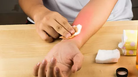 Cel mai simplu mod de vindeca arsurile! Un ingredient banal te scapă de usturime în câteva secunde