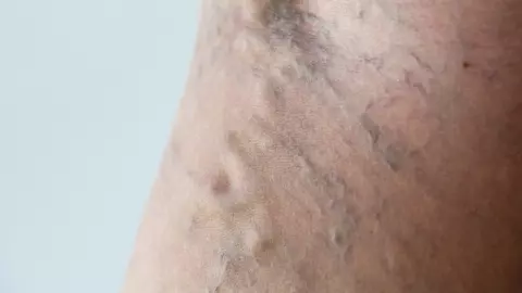 Ceapa roșie vindecă varicele! Cum se prepară remediul naturist care dă rezultate senzaționale