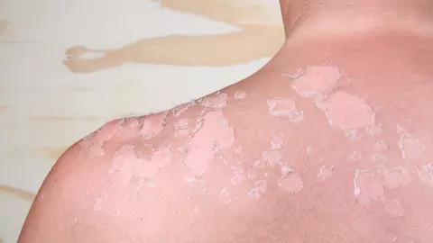 Cum să vindeci arsurile solare cu produse naturale. Iată cele mai bune remedii